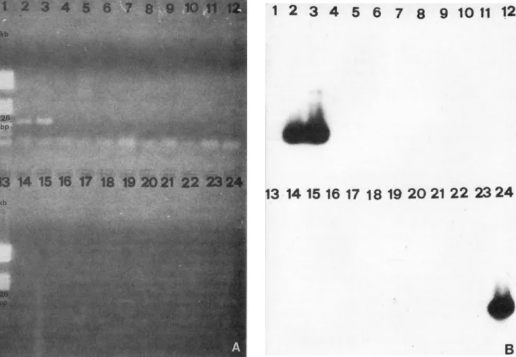 Figure 1. A.  Varicella-zoster virus (VZV) DNA (126 by in length) detected in aqueous humor samples from patients with necrotizing retinopathies; band patterns after 35 amplification cycles