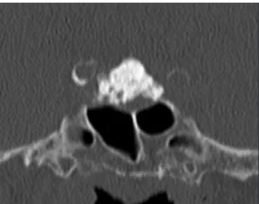 Figure 1: CT image in a coronal view, centred on the sellar space and showing a largely calcified sellar mass.