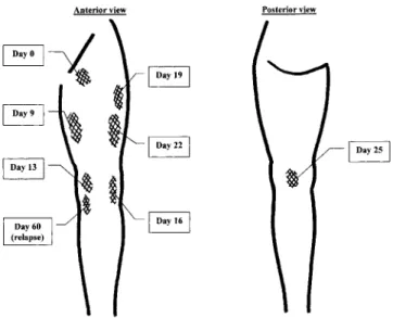 Figure 1. Migration of the subcutaneous swelling on the left lower limb.