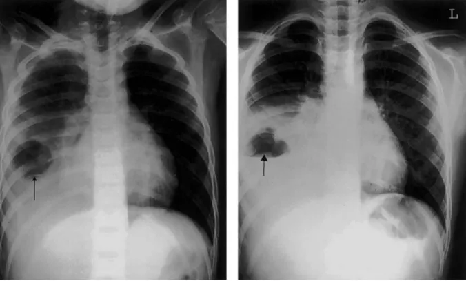Figure 1. A, Supine chest radiograph revealing a cavitary lesion within a consolidated right lower lobe, as well as a small pleural effusion