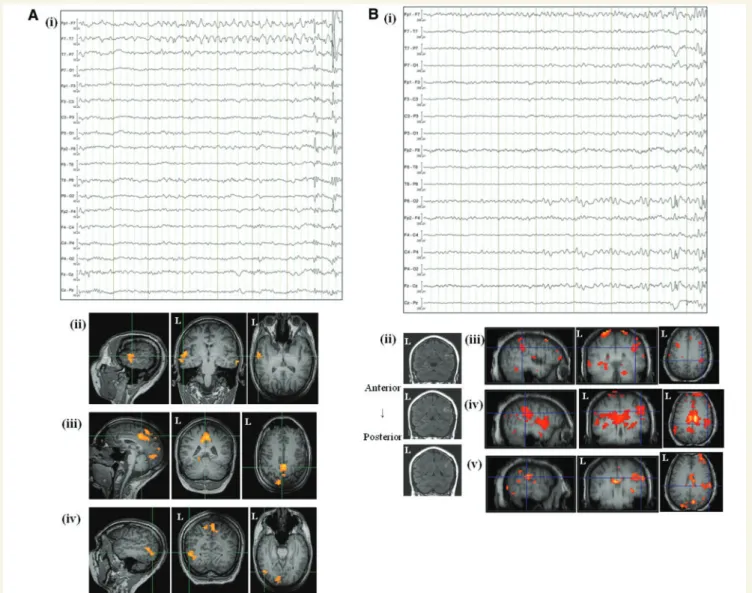 Table 1). Moreover, in six patients with frontal lobe seizures and difficult to localize ictal EEG, the global-maximum ictal onset phase-related BOLD cluster was localized within the presumed seizure onset zone at sub-lobar level in four patients.