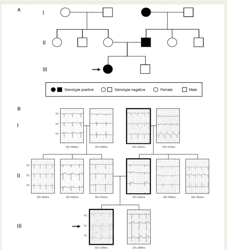 Figure 3 (A) Pedigree of the reported family. (B) Right precordial electrocardiographic leads (V1, V2, and V3; 25 mm/s; electrodes were placed in the normal position) and the QTc intervals of the family members