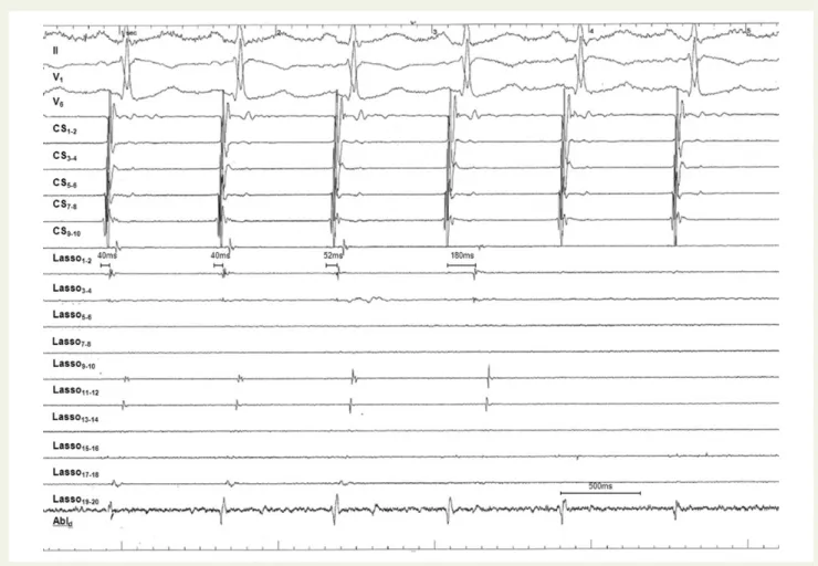 Figure 4 Image integration technology combines the electroana- electroana-tomical reconstruction of the left atrium (green) and the  fluoros-copy image into a single overlapping image aiming to reduce radiation exposure for both the patient and the operato