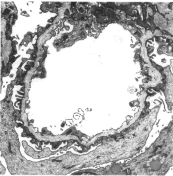 Fig. 2. Peripheral glomerular capillary loop: the basement membrane shows thinning and splitting of the lamina densa.