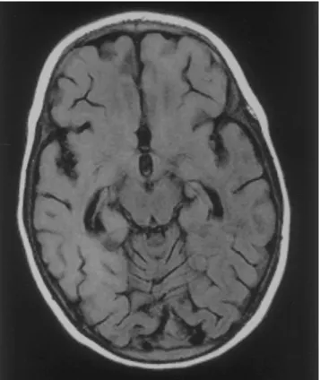 Figure 1. MRI from the brain of a 25-month-old patient with sub- sub-acute sclerosing panencephalitis, showing increased signal intensity of the complete right hemisphere and the left frontal lobe.