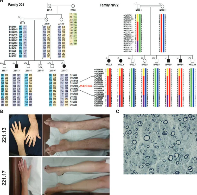 Figure 1. Characterization of two families affected with an intermediate form of CMT. (A) Haplotype reconstruction for 20 SNPs and 12 microsatellite markers of the chromosome 1p36 region in families 221 and NP72