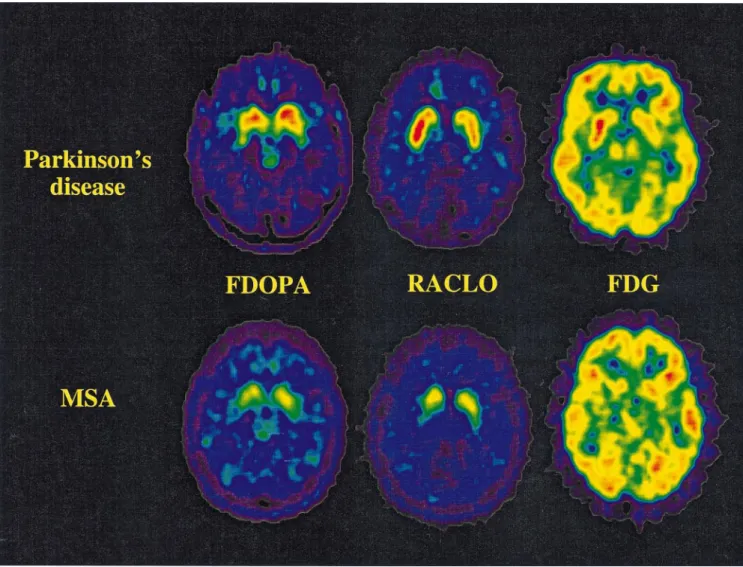 Fig. 1 Representative PET images of FDOPA, RACLO and FDG at the mid-striatal level from one patient with Parkinson’s disease (PD) (top row) and one patient with multiple system atrophy (MSA) (Patient 3; bottom row)