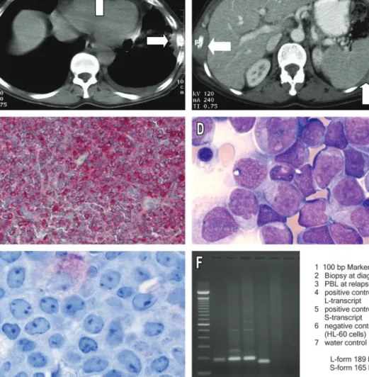 Figure 1. (A, B) CT scan at diagnosis showing large pleural tumors. (C) Pleural biopsy demonstrating blasts staining positive for myeloperoxidase, indicating granulocytic sarcoma