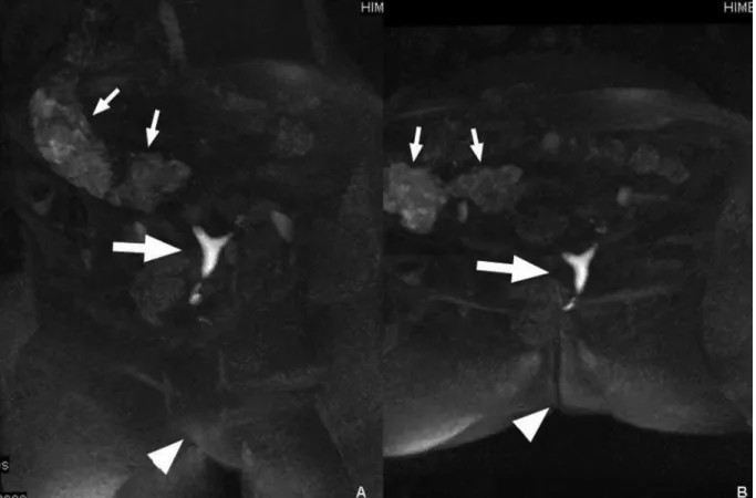 Figure 1. Three dimensional dynamic MR-HSG with overview maximum intensity projections acquired early during uterine injection of a higher viscosity gadolinium-polyvidone solution allows perfect 3D visualization of the uterine cavity within the body from d