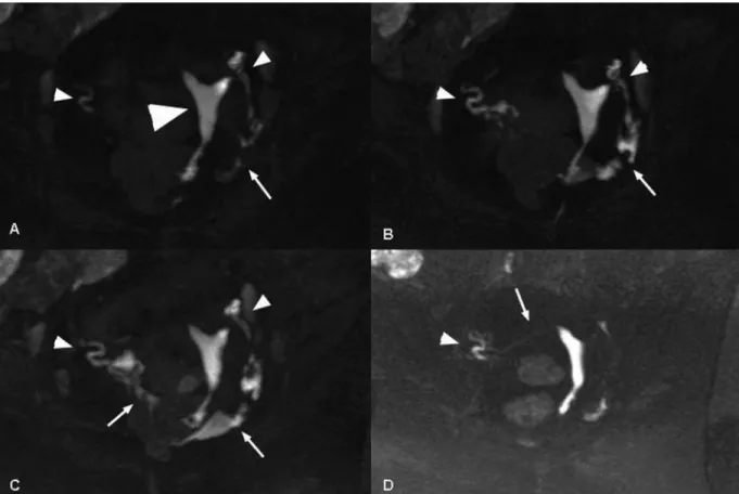 Figure 2. Three dimensional dynamic MR-HSG with maximum intensity projections (MIP) acquired early (A) and during late (B) as well as after (C) uterine injection of a gadolinium-polyvidone solution allows perfect 3D visualization of the uterine cavity (lar