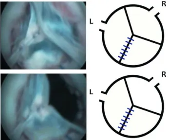 Figure 1: Endoscopic view of an arti ﬁ cially created bicuspid aortic valve. (A) Diastolic position, (B) systolic position