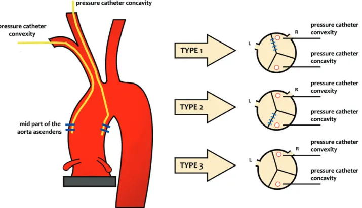Figure 3: Pressure catheters and valve conﬁgurations. The raphes between the sewn aortic valve leaﬂets are marked blue