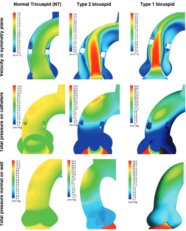 Figure 6: CFD blood ﬂow simulations in the ascending portion of the aorta. Comparison of velocity and total pressure in healthy tricuspid (NT), Type 2 and Type 1 bi- bi-cuspid con ﬁ gurations