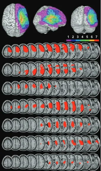 Fig. 2 Overlap map and individual lesions of neglect patients.