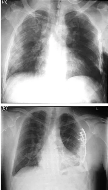 Fig. 2. CT of the thorax on admission with the rib fractures and the chest- chest-wall deformity.