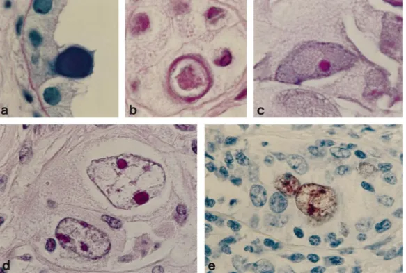 Fig. 1. Di ff erent types of intranuclear viral inclusion bodies in epithelial cells. (a) Amorphous ground-glass variant; PAS stain, 340 × original magnification