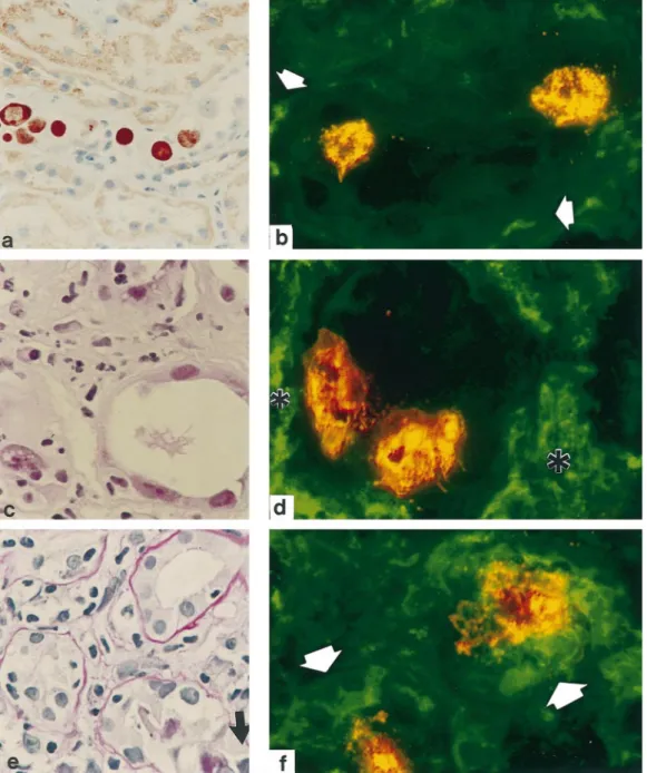 Fig. 3. Interstitial changes and tubular MHC-class II (HLA-DR) expression in BKN. (a) No inflammatory response is seen in the interstium adjacent to a tubule with inclusion bearing cells (red brown); immunohistochemical detection of SV40 T antigen, 110 × o