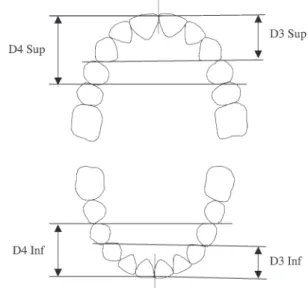 Figure 2        Depth measurements based on the distance between the contact  points of two pairs of teeth, and the contact point between the corresponding  pair of incisors in the same arch
