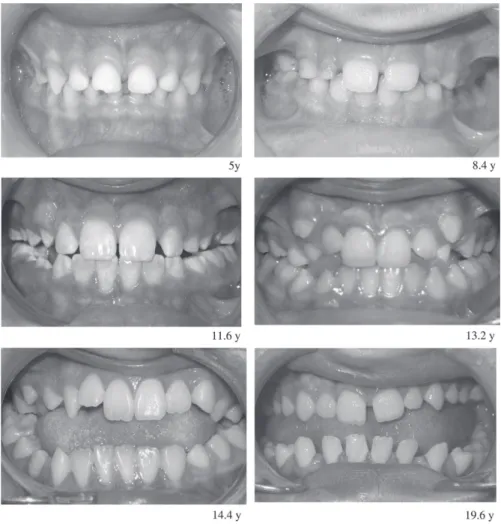 Figure 6        Anterior view of teeth in occlusion in various Duchenne muscular dystrophy (DMD) patients  at the ages of 5.0, 8.4, 11.6, 13.2, 14.4, and 19.6 years