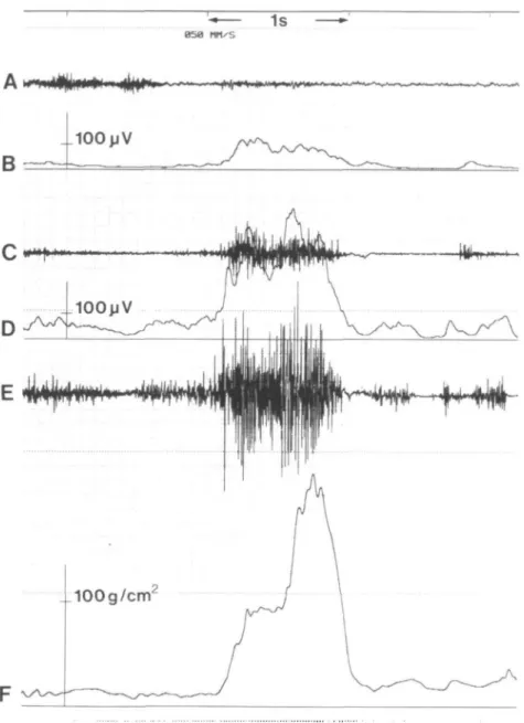 Figure 9 Electromyographic and lip pressure recording of swallowing. (A) Direct recording of masseter muscle activity