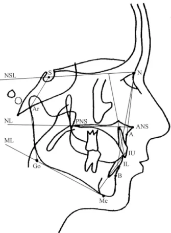Figure 1  Landmarks and reference lines used in the cephalometric analy- analy-sis. S, sella; N, nasion; ANS, anterior nasal spine; PNS, posterior nasal  spine; A, cephalometric point A; B, cephalometric point B; Me, menton; 