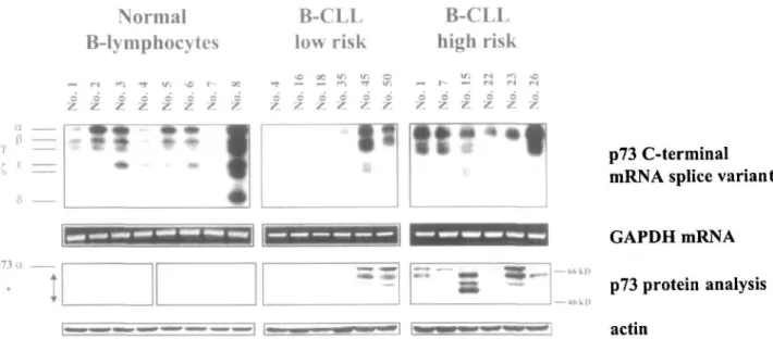 Figure 2. Expression of p73 C-terminal mRNA splice variants and p73 protein analysis of a population of normal CD19+-B-lymphocytes and representative samples of patients with B-CLL from two different risk groups