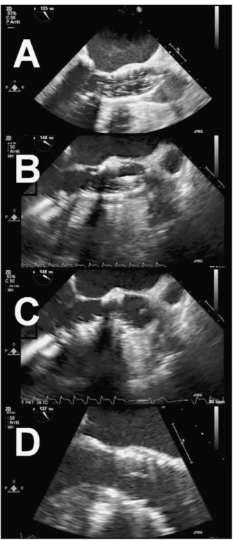 Fig. 1. (A) Selective three-dimensional aortic root reconstruction from the preoperative cardiac CT-scan: the perspective of the aortic valve plane is identified and measured as number of degrees in cranio-caudal and lateral orientation