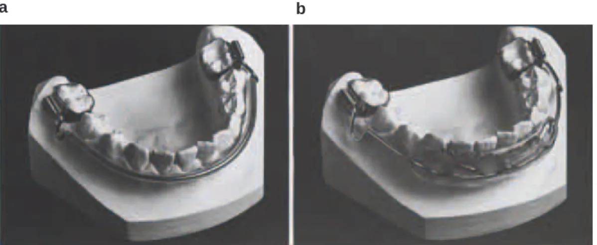 Figure 1 The lip bumper used in group I (a), and in group II (b).