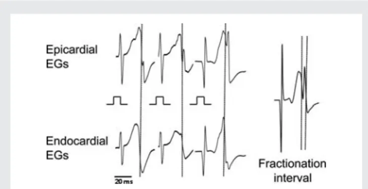 Figure 6 Left: Examples of epicardial short double potentials during rapid atrial pacing