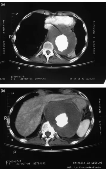 Fig. 1. CT scan demonstrates huge thoraco-abdominal aneurysm with com- com-pression of the stomach and the heart (a) and erosion of a vertebral body (b).