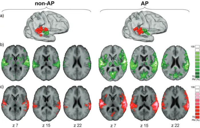Figure 6. FMRI-based functional connectivity of right HG and PT. ( a ) Individual localization of the fMRI center of gravity of right-hemispheric HG (green) and PT (red) coordinates in non-AP musicians and AP musicians
