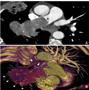 Fig. 2. Histopathology. (A) Low magnification of sample obtained from endovascular biopsy (haematoxylin-eosin stain 40!)