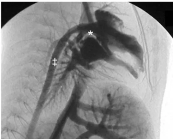 Figure 1: Fetal cardiac anatomy. Post-mortem angiography through umbilical vein including descending aorta ( ‡ ) and the ductus arteriosus at its entry into the aortic arch (*).