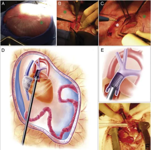 Figure 2: The fetal open-chest in utero trans-apical hybrid technique. After exteriorization of the uterus (A), a small incision was made in the uterine wall (B, *A–C: