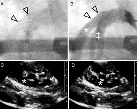 Figure 5: The stent (A and B, arrows) was deployed into the pulmonary artery (C and D, *)