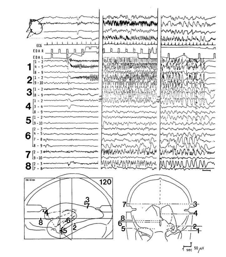 Figure I — Combined scalp- and depth EEG recordings at onset, peak, and end of a spontaneously occurring complex partial seizure