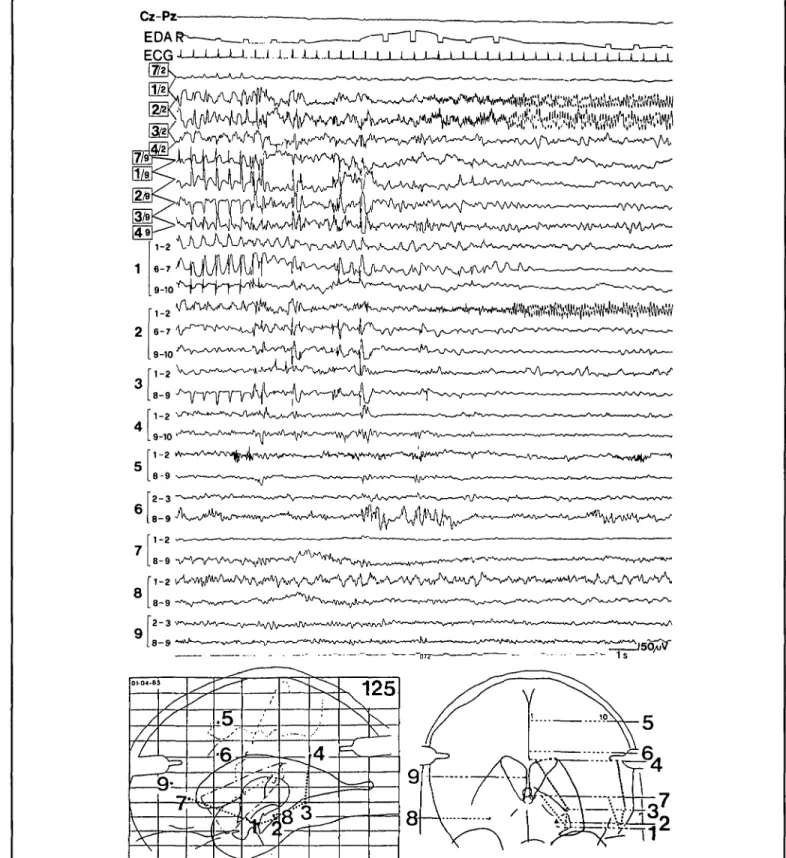 Figure 2 — Example of depth EEG recording at the onset of a seizure, characterized by an aura of detachment