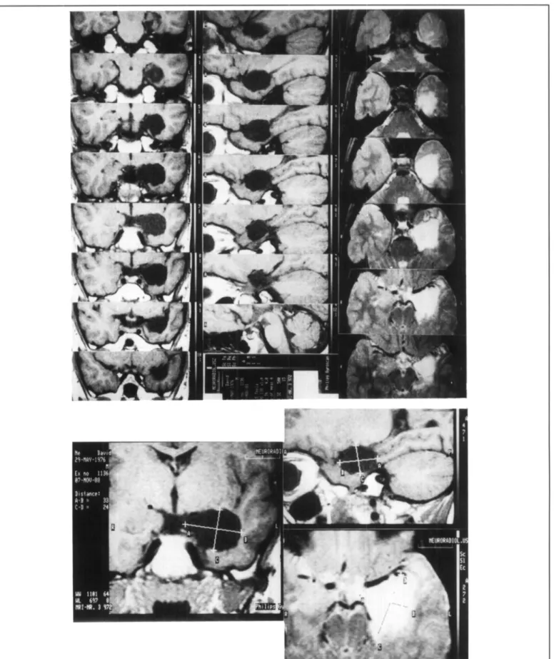 Figure 3 — Serial postoperative MR-images in all three planes showing the extent of a left selective amygdalohippocampectomy