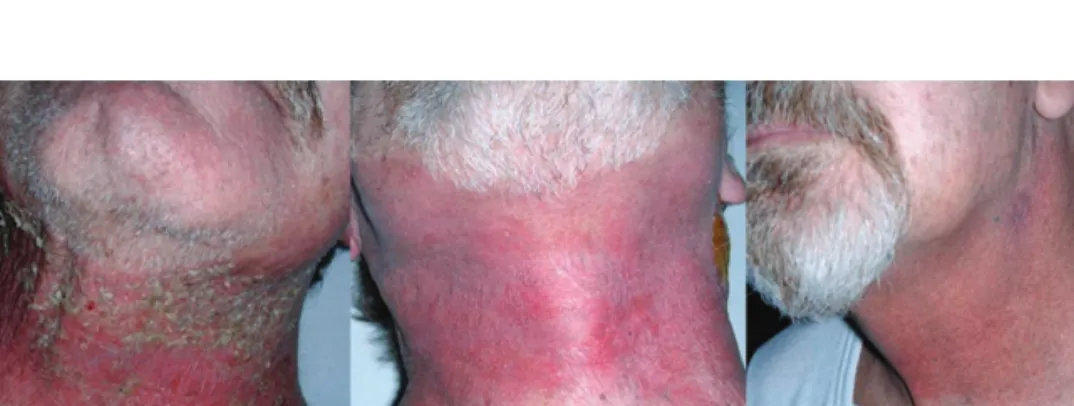 Figure 3. Time course of radiation dermatitis in a patient receiving cetuximab and radiotherapy