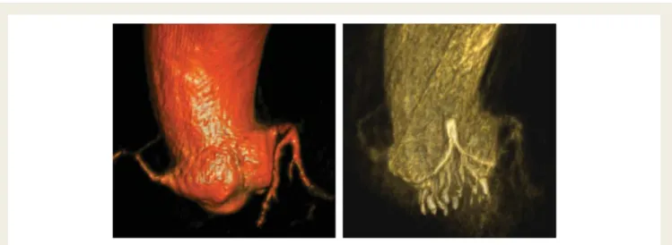 Figure 6 Angiography before deployment (right anterior oblique projection). A local dissection (extravasation) can be identified in direct continuation of the exposed prosthetic  com-missural post of the crimped valve (arrow) above the  non-coronary sinus 