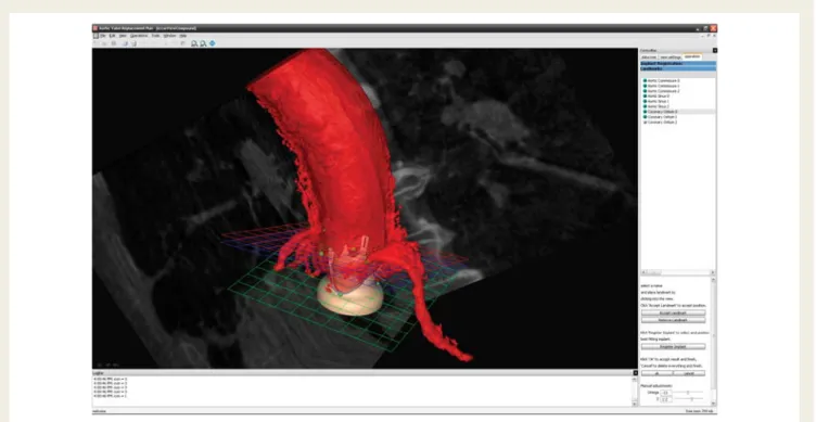 Figure 10 Preoperative planning using virtual implants in 3D reconstruction of the aortic root derived from intraoperative Dyna-CT data demonstrating perfect anatomical alignment.