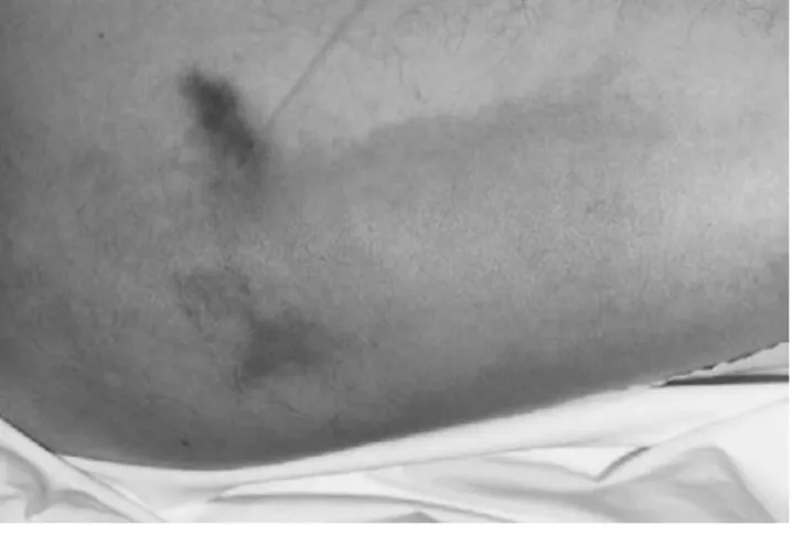 Figure 1. Necrotizing fasciitis due to Streptococcus pneumoniae after im injection of nonsteroidal anti-inflammatory drugs in a 68-year-old man (left thigh with site of injection on admission)