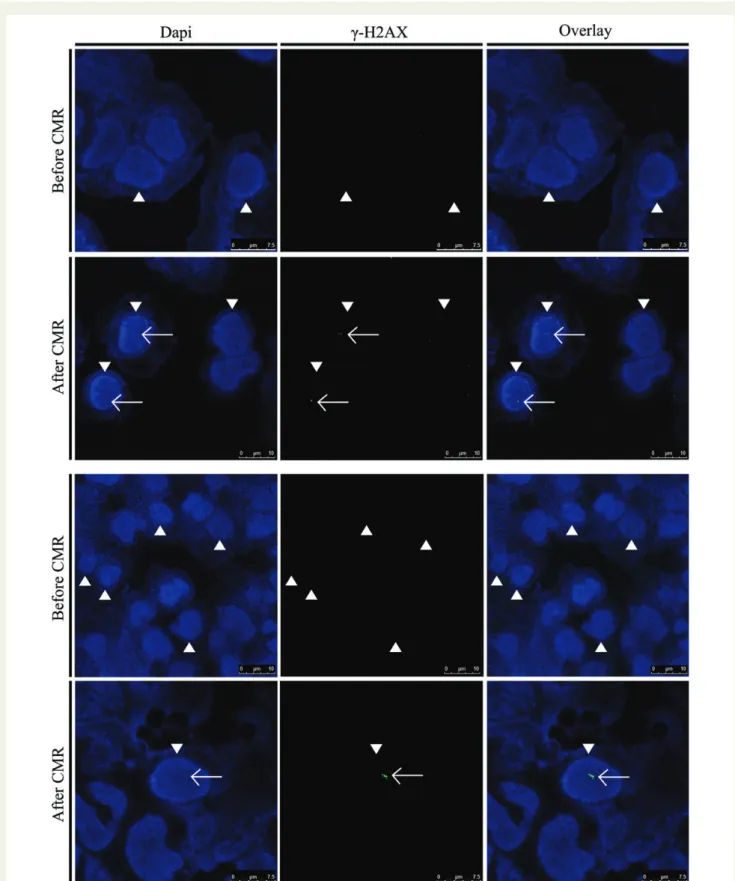 Figure 1 Visualization of double-strand breaks (DSBs) in nuclei (arrow heads) of human lymphocytes of two patients before and after cardiac magnetic resonance scans by immunofluorescence microscopy