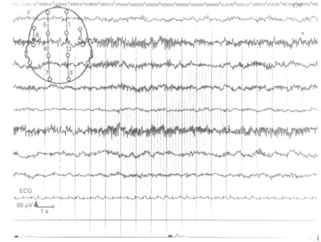 FIG. 1. EEG after induction demonstrating beta and theta activities: no spontaneous excitatory movements.