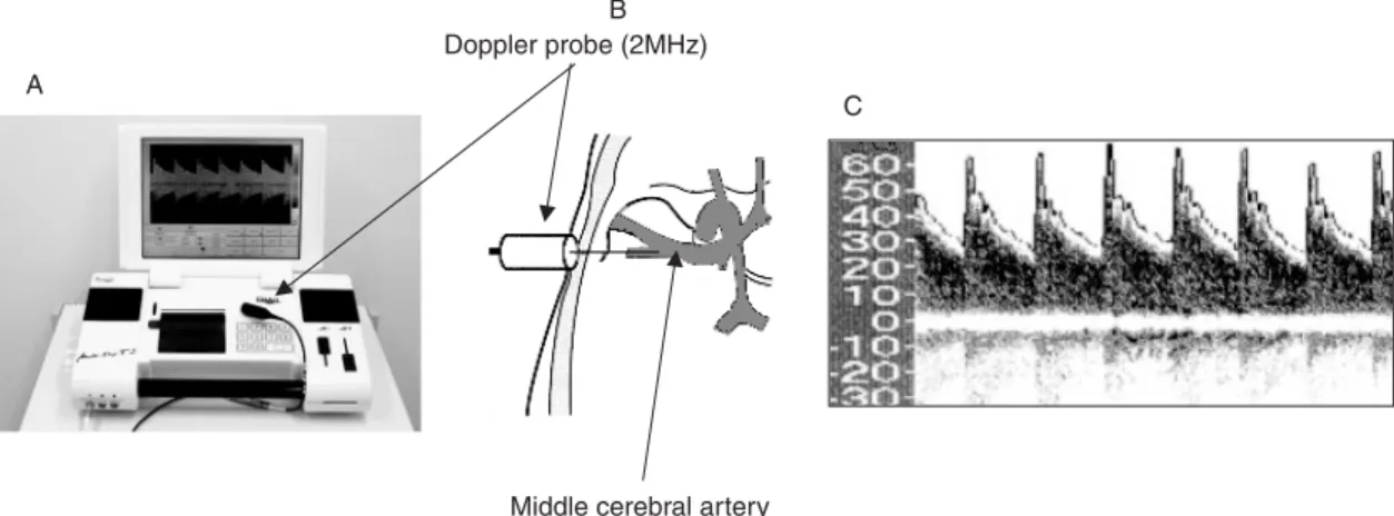 Fig 6 Transcranial Doppler. ( A ) Typical transcranial Doppler machine. (B ) Illustration of insonation of middle cerebral artery through temporal bone.