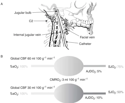 Fig 4 Jugular bulb oximetry. ( A ) Catheter inserted into the internal jugular vein. The tip of the catheter must lie in the jugular bulb or at or above the level of the body of the 2nd cervical vertebra (C2)