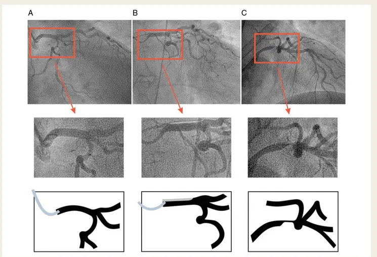 Figure 1 Coronary angiogram with magnified views (middle rows) and schematic drawings (bottom rows) of the left coronary artery obtained at different time points during the exam (columns A, B, and C)