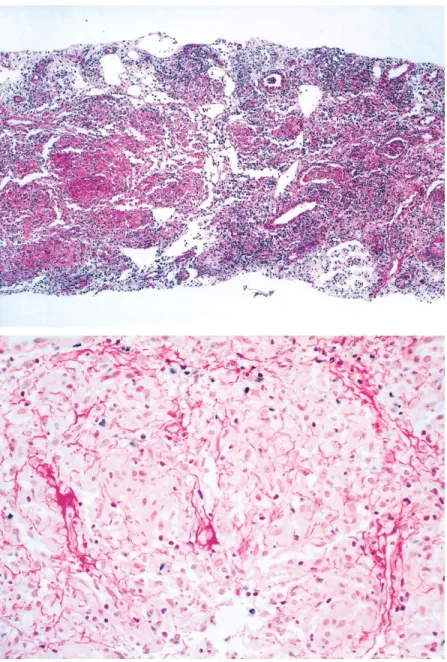 Figure 2. Micrographs of a renal biopsy specimen showing granulomatous nephritis ( top, hematoxilin-eosin stain; original magnification 5⫻) with nonnecrotizing epitheloid granuloma and faint fibrosis (bottom, sirius stain; original magnification 200⫻).