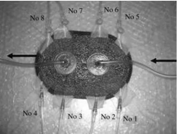 Figure 1 V.A.C.  instillation model with catheters.
