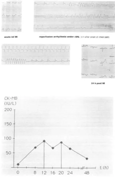 Figure 1 27-year-old man with acute infer- infer-ior myocardial infarction undergoing  throm-bolytic therapy with rtPA 3-3 h after onset of chest pain